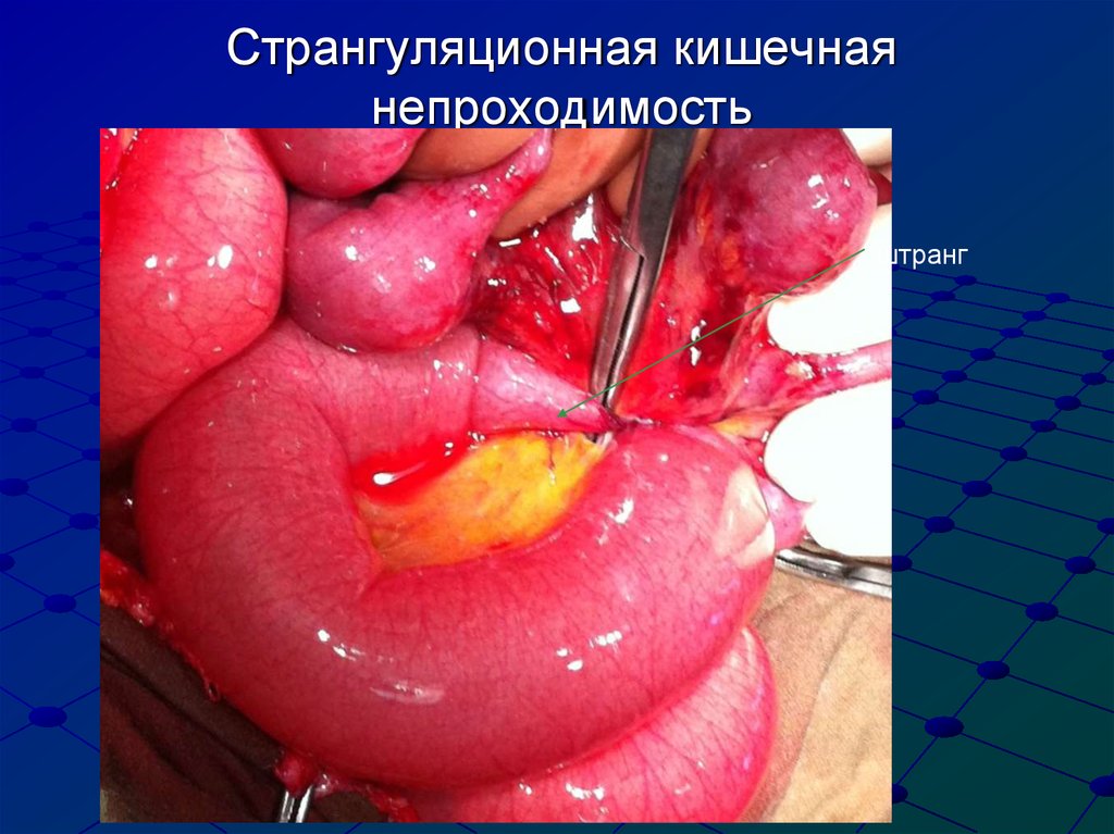 Странгуляционная кишечная непроходимость