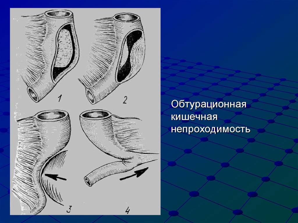 Обтурационная форма рака. Механическая обтурационная кишечная непроходимость. Интраорганная кишечная непроходимость. Обтурационной кишечной непроходимости. Обтурационная толстокишечная непроходимость.