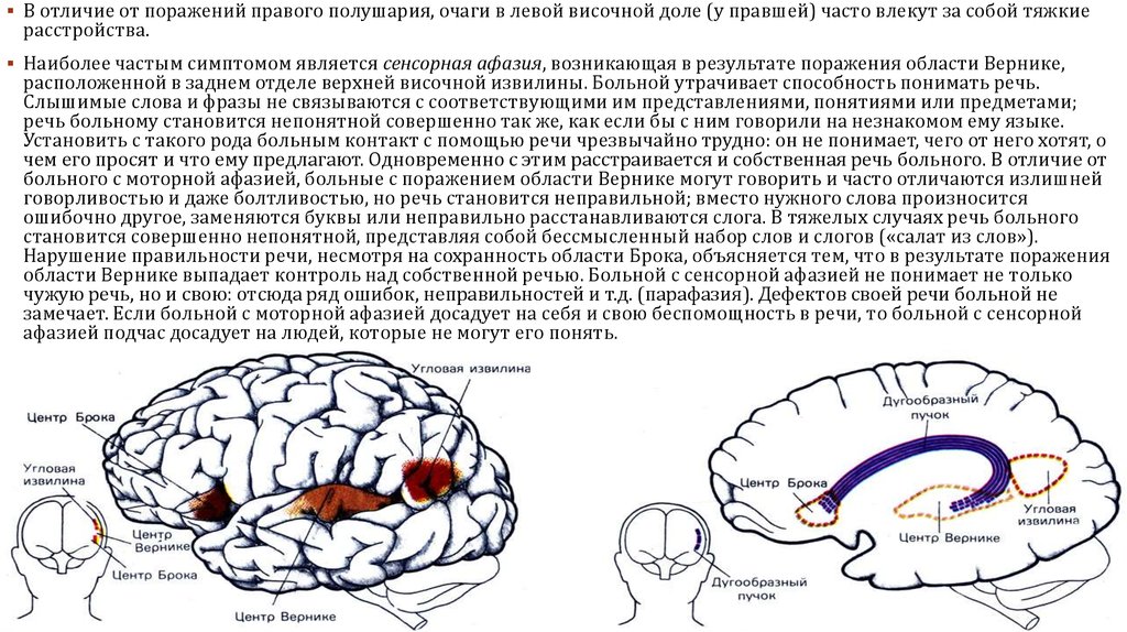 Инсульт левого полушария головного