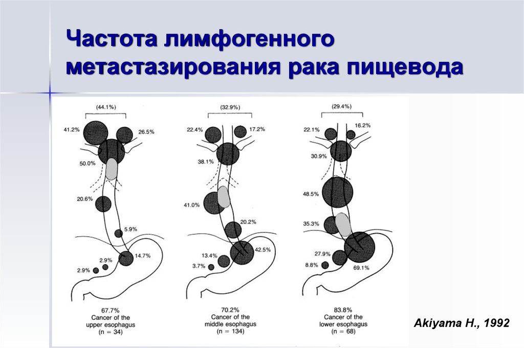 Рак пищевода метастазы