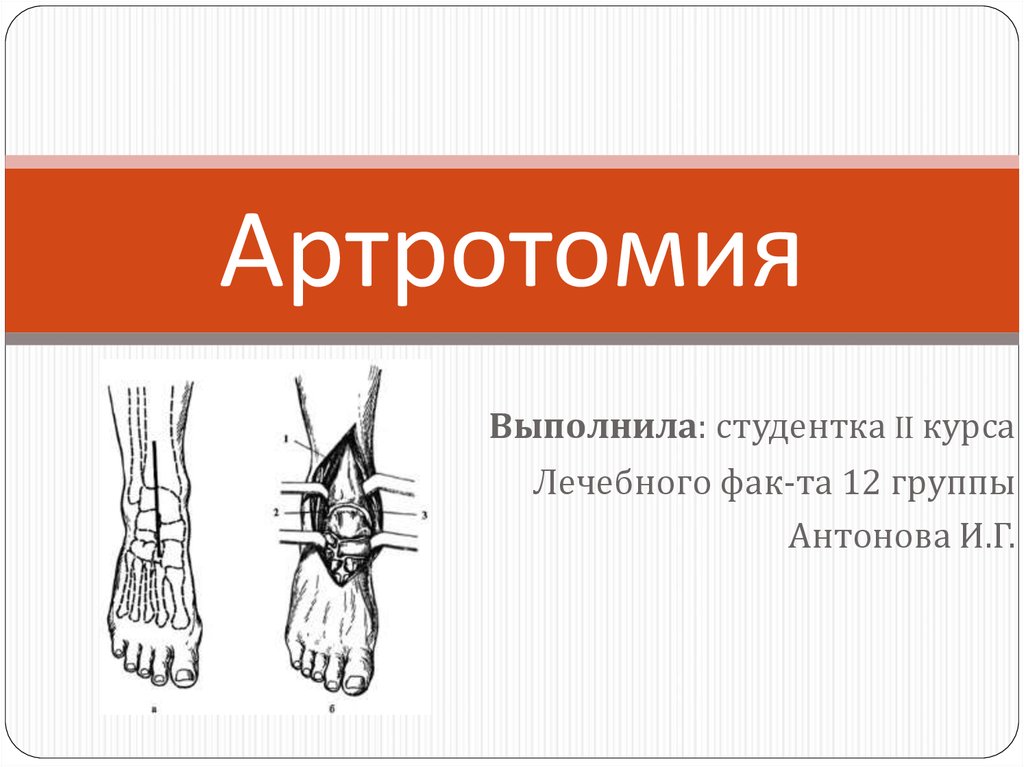 Артротомия плечевого сустава. Артротомия по Текстору. Артротомия коленного сустава.