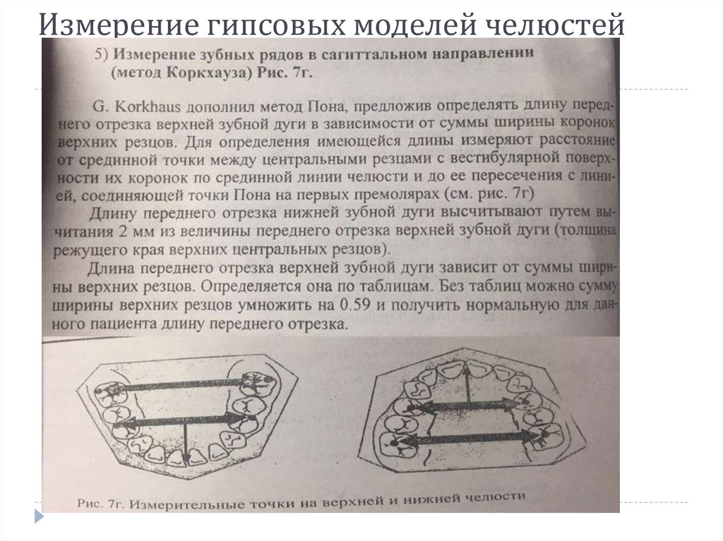 Метод пона. Изучение моделей челюстей по методу Коркхауза?. Измерение гипсовых моделей. Измерение моделей челюстей. : Антропометрические измерения гипсовых моделей.