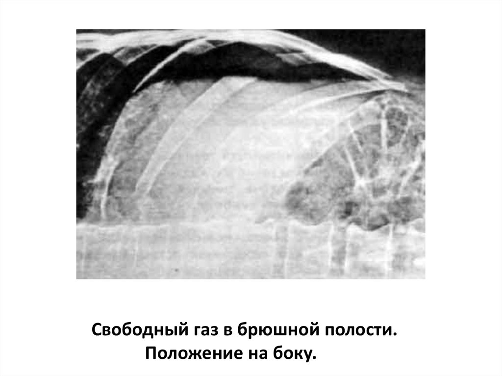 Свободный газ. Свободный ГАЗ В брюшной полости латеропозиция. Свободный ГАЗ В латеропозиции. Свободный ГАЗ В брюшной полости рентген латеропозиция. Свободный ГАЗ на латерограмме.