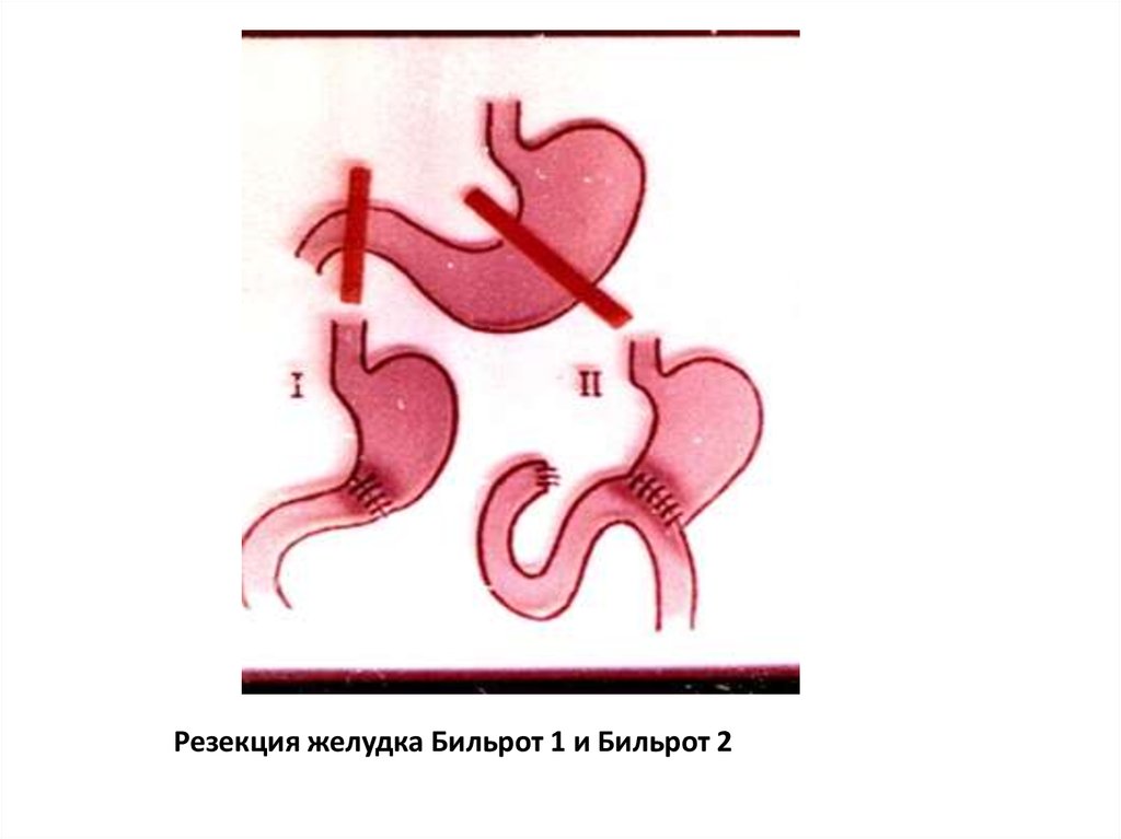 Бильрот 1 и 2 схема кратко