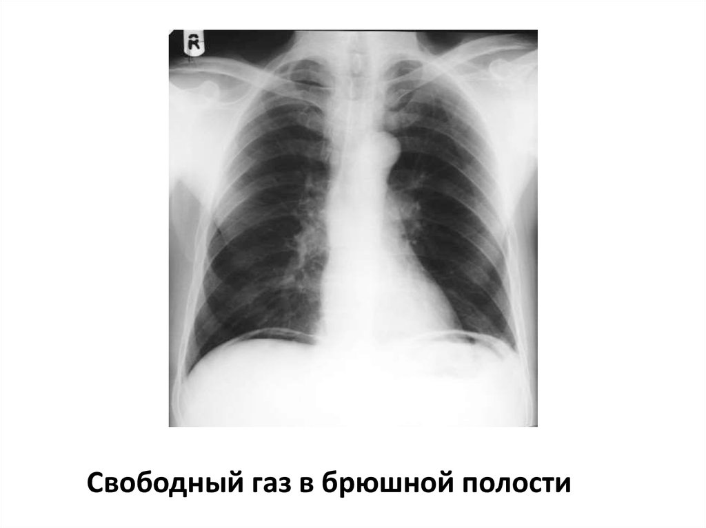 Полость свободно. Свободный ГАЗ В брюшной рентген. Свободный ГАЗ В брюшной полости на рентгенограмме. Рентгенография прободной язвы. Свободный ГАЗ В брюшной полости при прободной язве желудка.