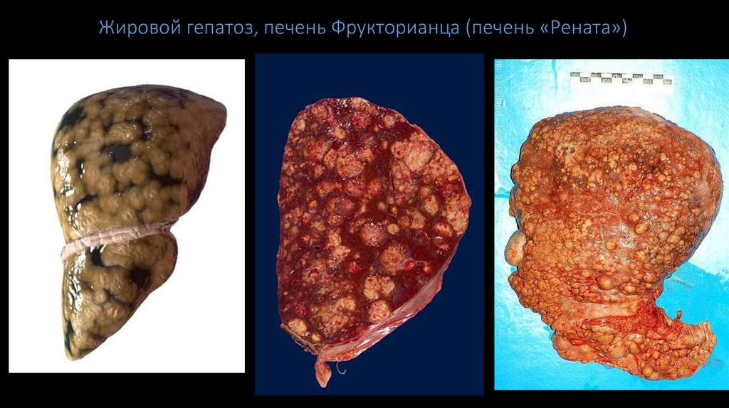 Жировой гепатоз, печень Фрукторианца (печень «Рената»)