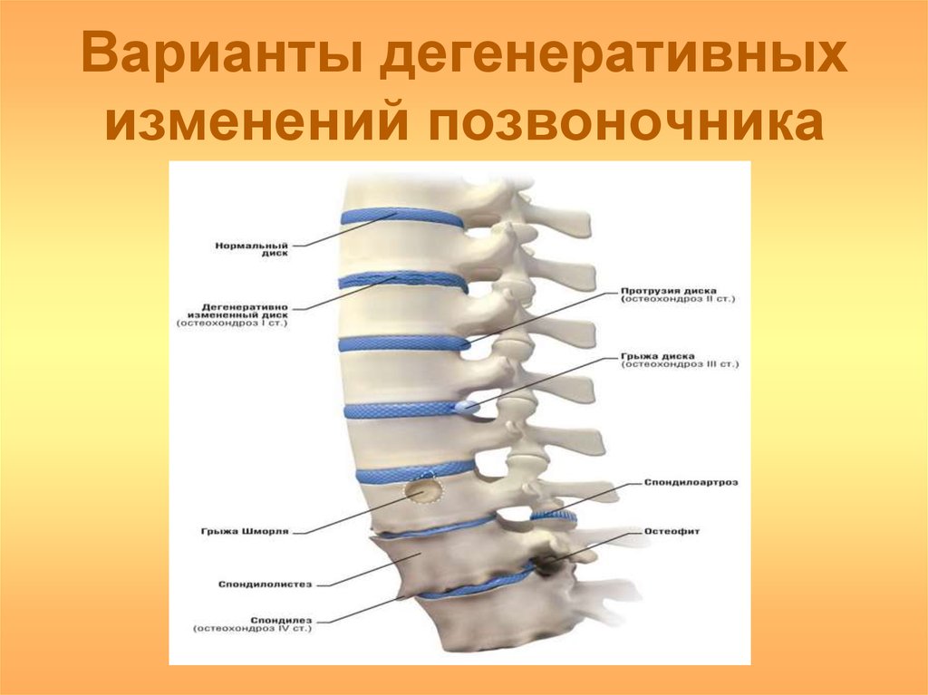 Мрт картина дегенеративно дистрофических изменений