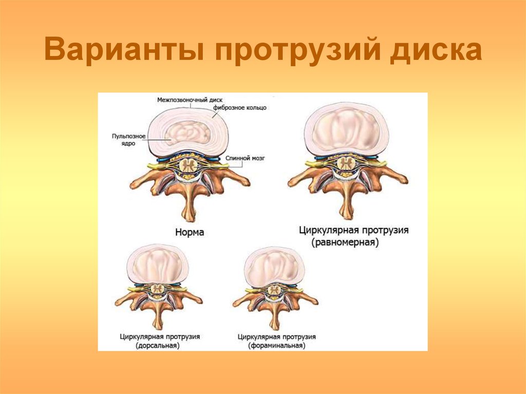 Диффузное выбухание межпозвоночного