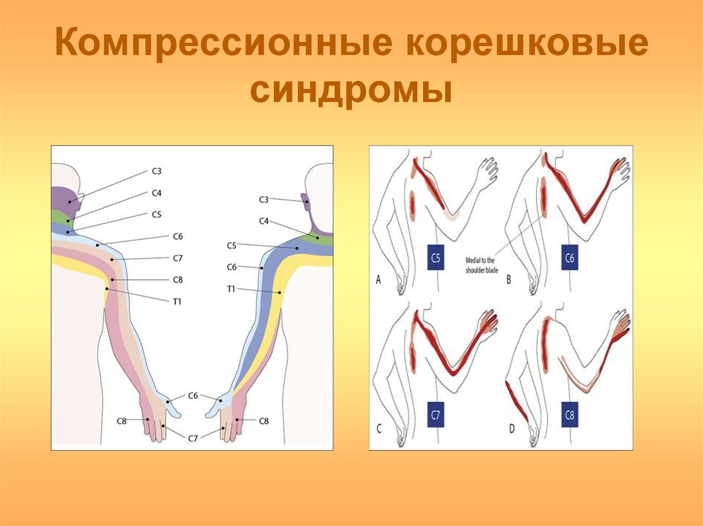 Схема лечения корешкового синдрома