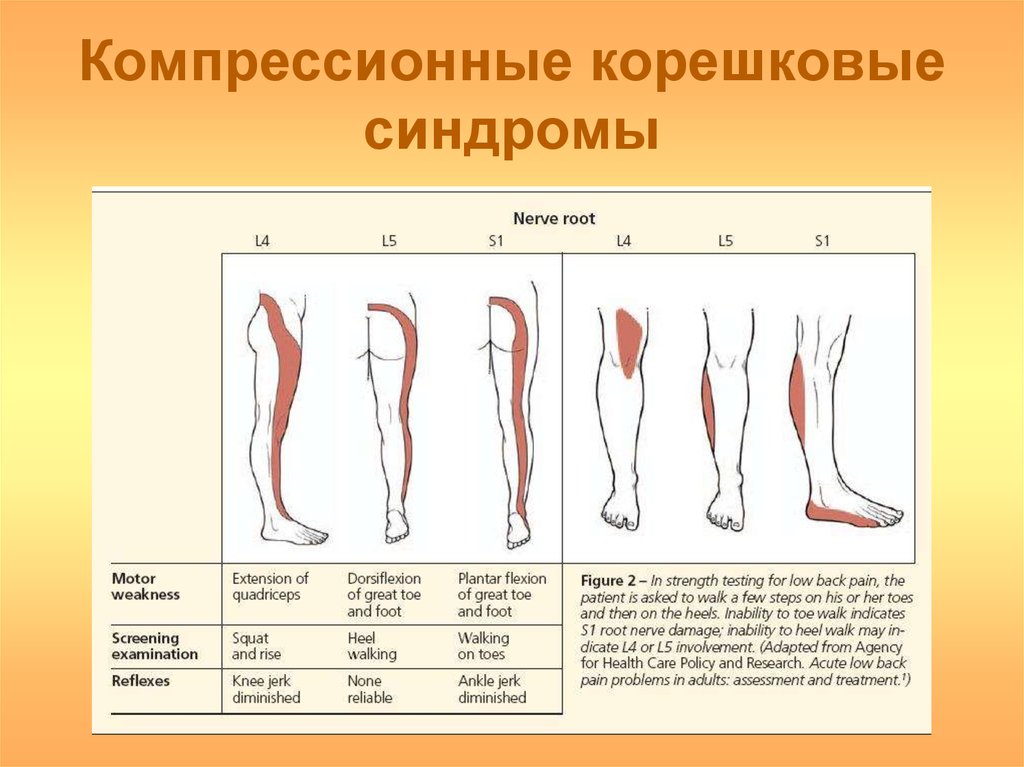 Корешковое поражение