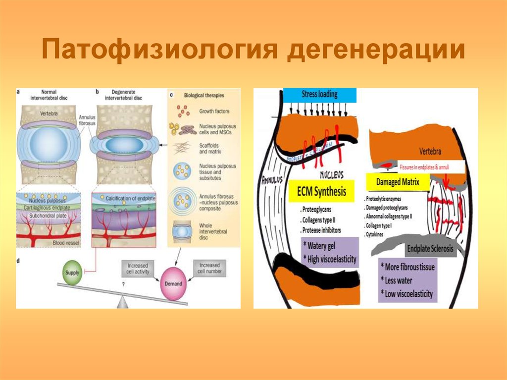 Дегенерация 3 степени