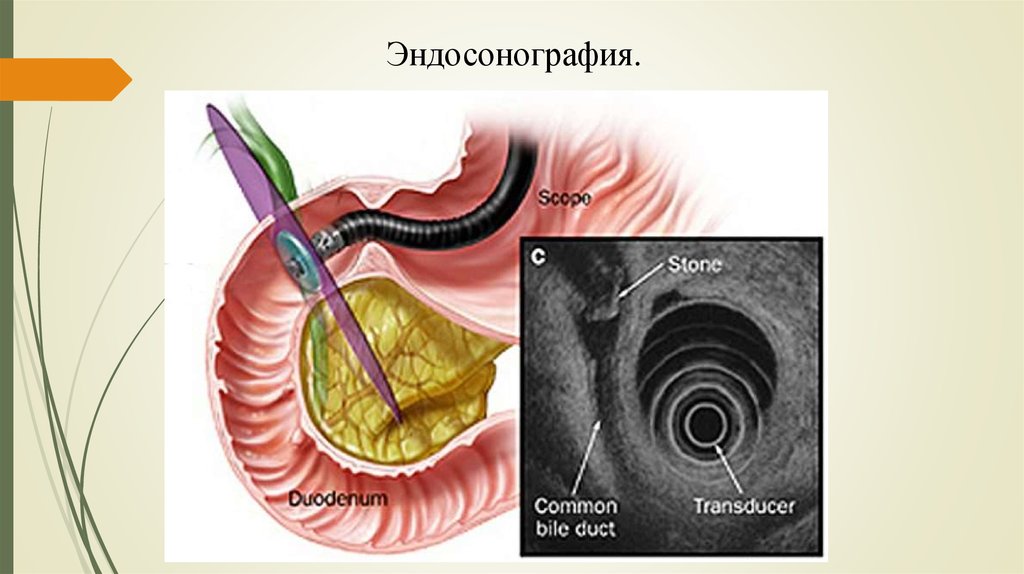 Биопсия пищевода. Эндоскопическая ультрасонография поджелудочной железы. Эндоскопическая ультрасонография хронический панкреатит. Эндосонография желчного пузыря. Эндоскопическая биопсия поджелудочной железы.
