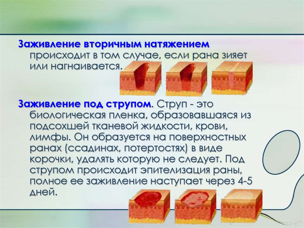 Сколько времени заживает. Этапы заживления РАН вторичным натяжением. Заживлен е вторичным гатяжением. Заживление РАН под струпом. Зажившение вторичныс наиядением.