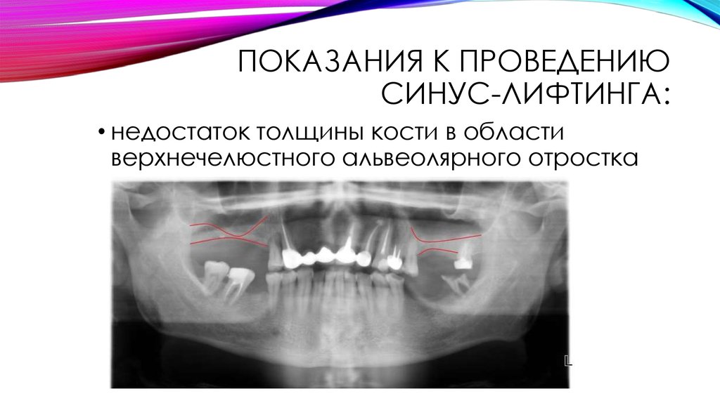 Презентация закрытый синус лифтинг