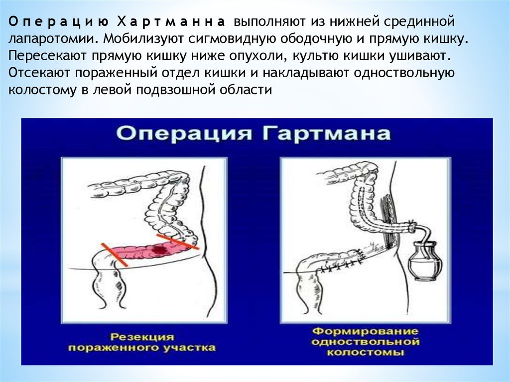 Рак прямой кишки карта вызова