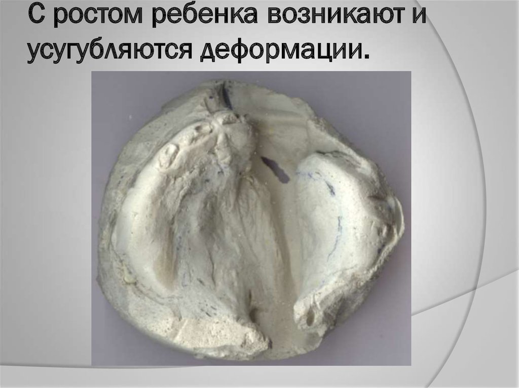 С ростом ребенка возникают и усугубляются деформации.