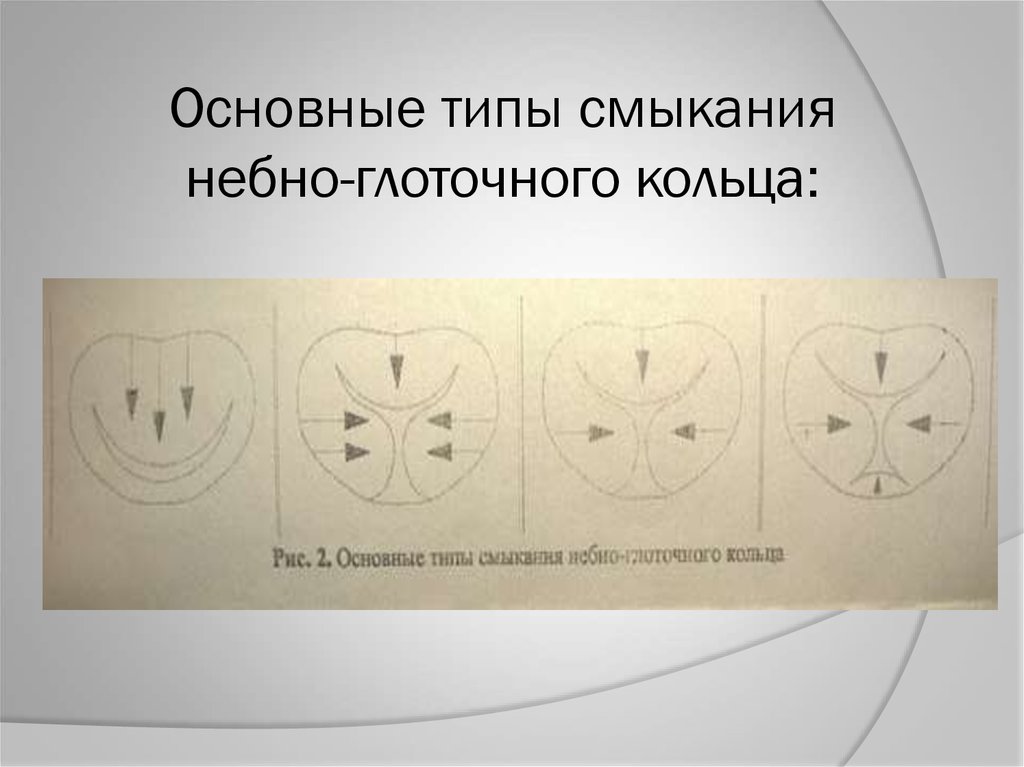 Основные типы смыкания небно-глоточного кольца: