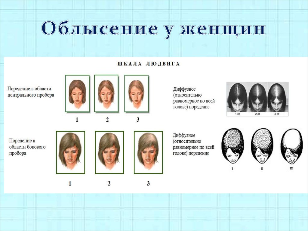 Психосоматика выпадение. Шкала выпадения волос. Шкала Людвига алопеция. Выпадение волос психосоматика. Шкала облысения у женщин.