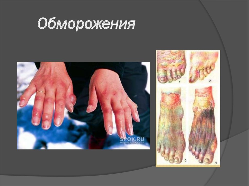 Обморожения 