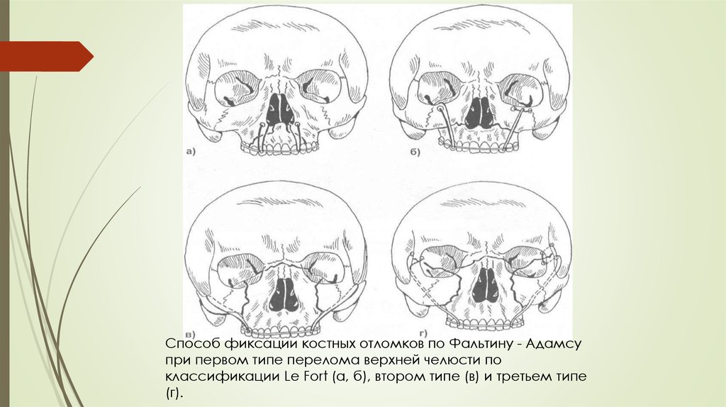 Перелом верхней челюсти презентация