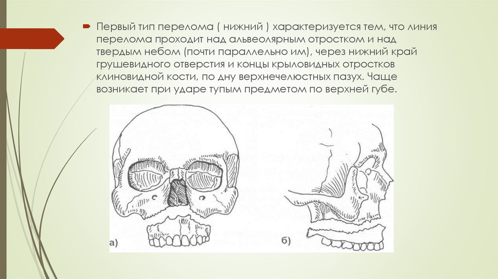 Перелом головки нижней челюсти