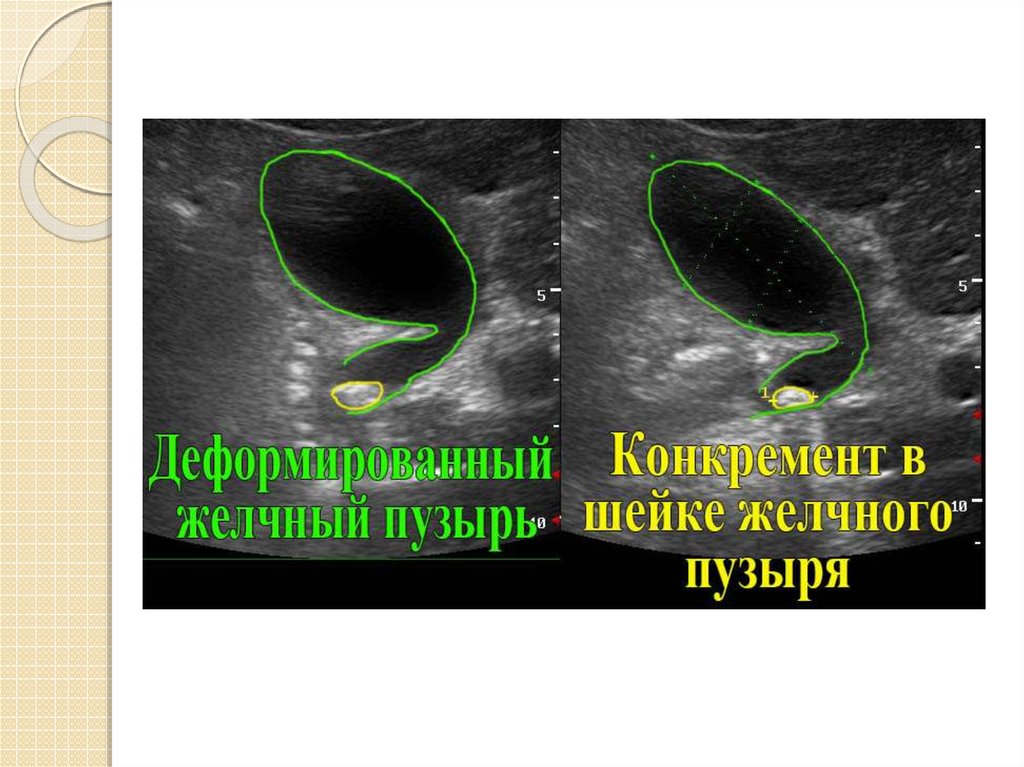 Загиб желчного пузыря. Деформированный желчный пузырь. Искривленный желчный пузырь. Деформация шейки желчного пузыря. Деформированный желчный пузырь с перегибом.