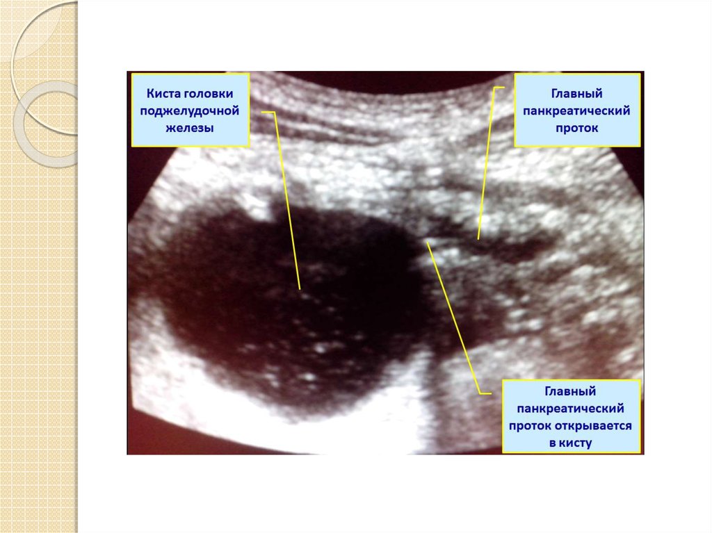 Кистозные железы. Псевдокиста поджелудочной железы на УЗИ. Киста поджелудочной железы на УЗИ. Киста головки поджелудочной железы на УЗИ. Ретенционная киста поджелудочной.