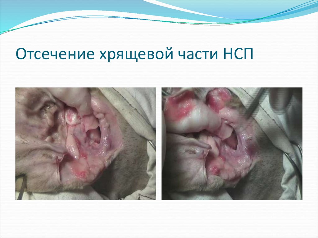 Отсечение хрящевой части НСП