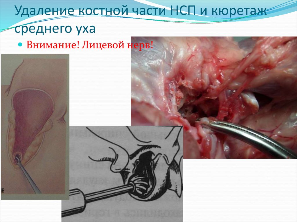 Удаление костной части НСП и кюретаж среднего уха
