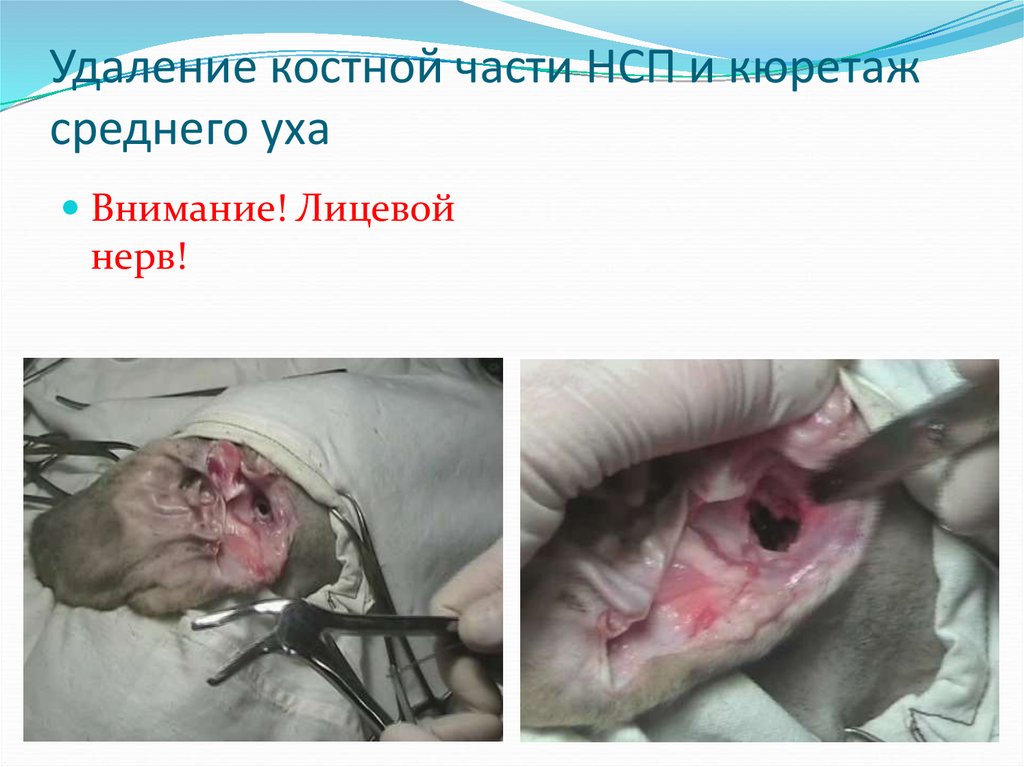 Удаление костной части НСП и кюретаж среднего уха