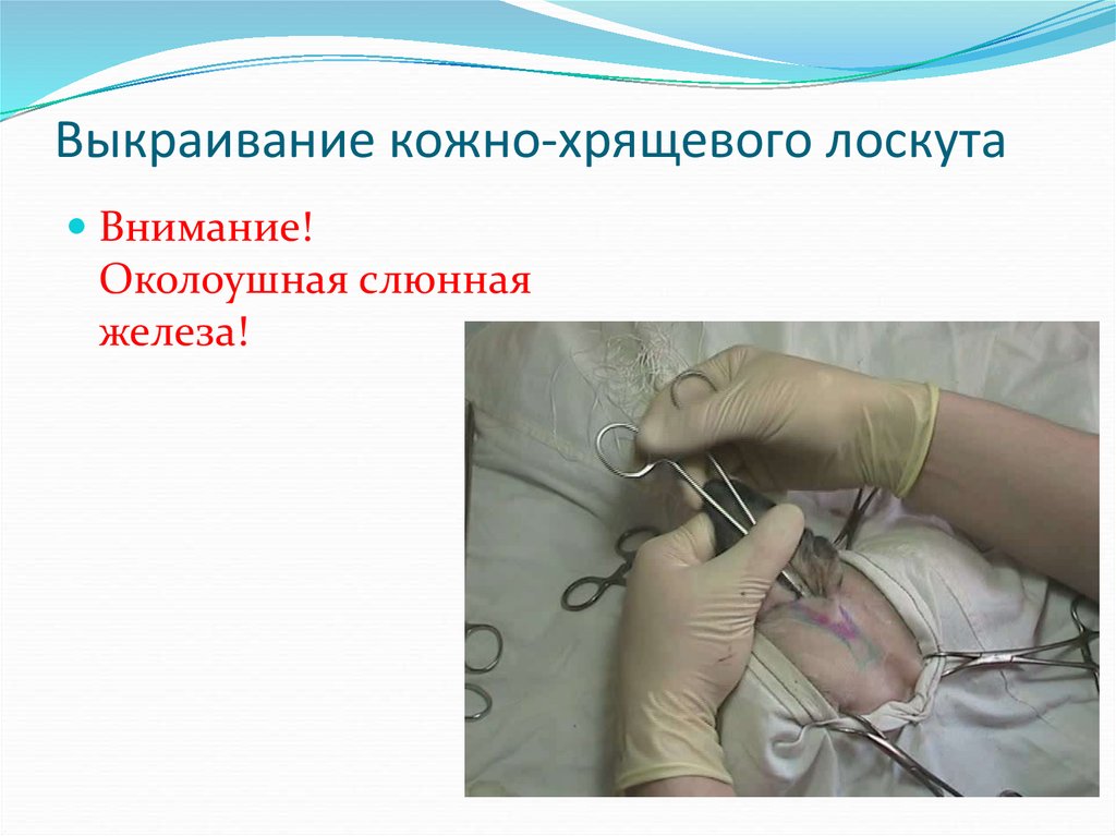 Выкраивание кожно-хрящевого лоскута