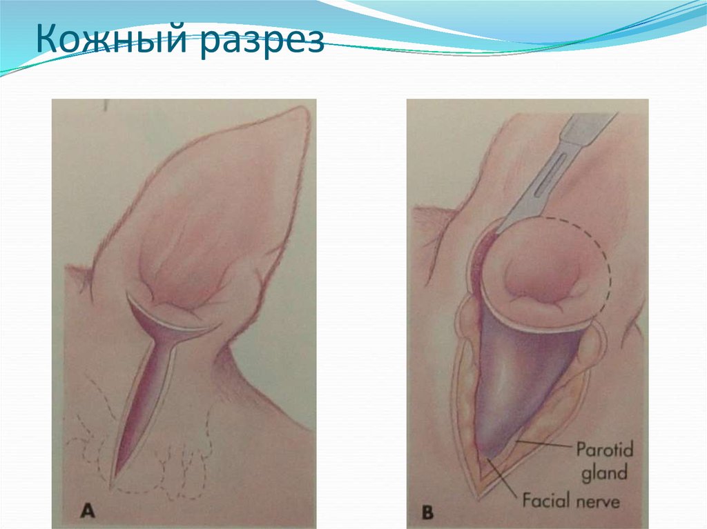Кожный разрез