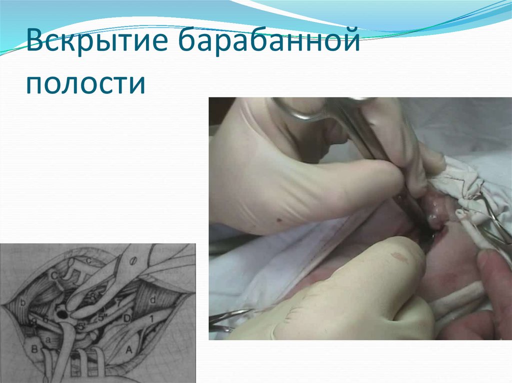 Вскрытие барабанной полости