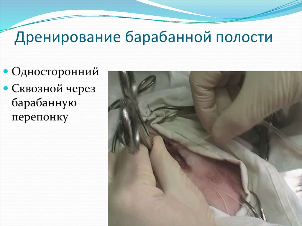 Дренирование барабанной полости