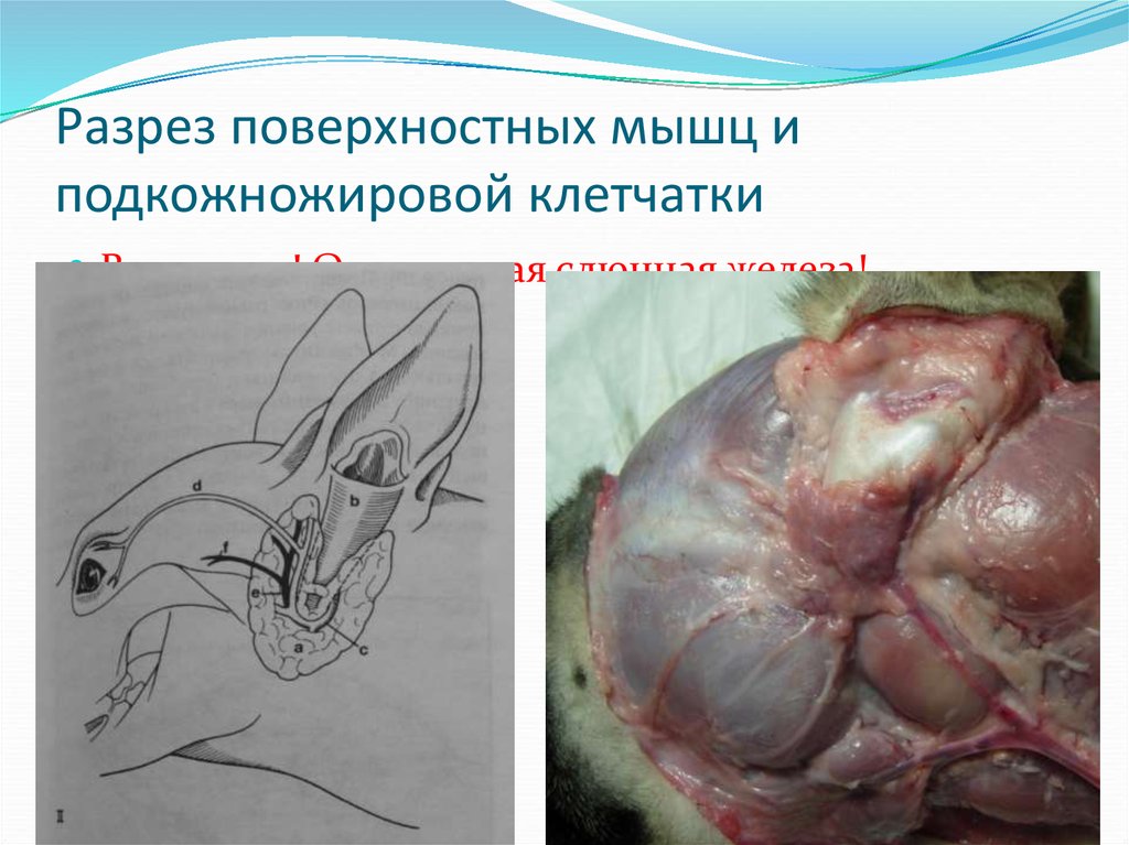 Разрез поверхностных мышц и подкожножировой клетчатки