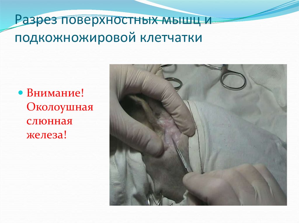 Разрез поверхностных мышц и подкожножировой клетчатки