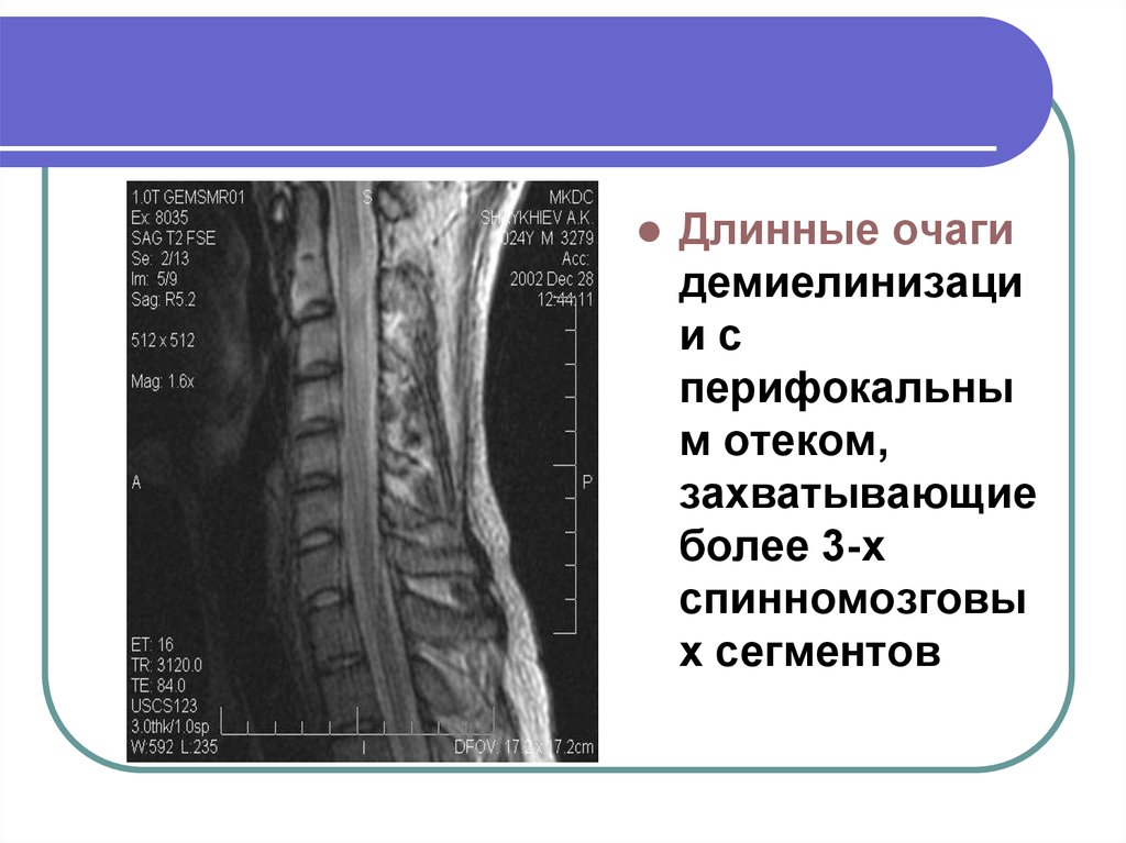 Признаки демиелинизирующего процесса. Демиелинизирующего заболевания. Демиелинизирующее заболевание классификация. Демиелинизирующий процесс в шейном отделе. Демиелинизирующие процессы спинного мозга.