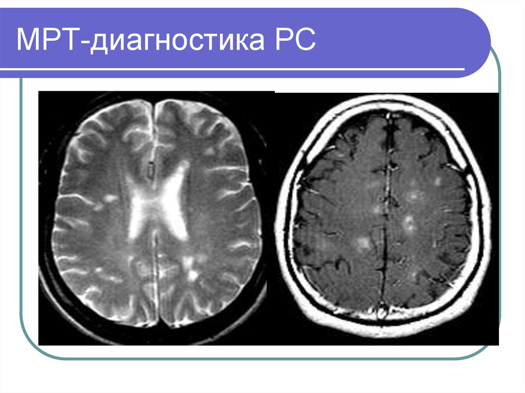 Мр картина демиелинизирующего заболевания головного мозга