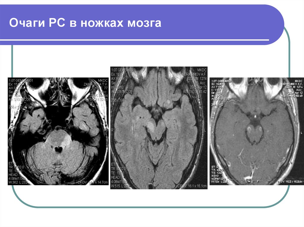 Очаг мозга. Ножки мозга мрт. Очаги в ножке среднего мозга мрт. Очаг в ножке мозга на мрт.