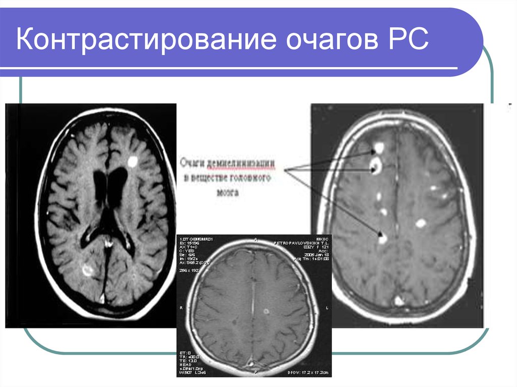 Дексаметазон при рассеянном склерозе схема