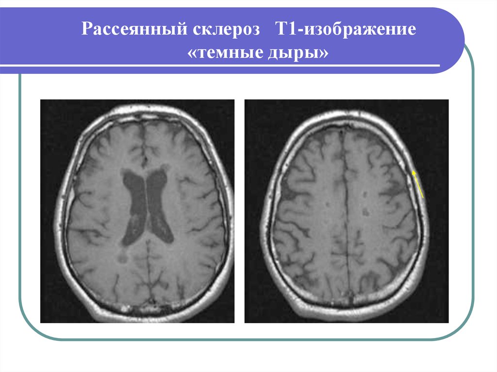 Признаки демиелинизирующего поражения