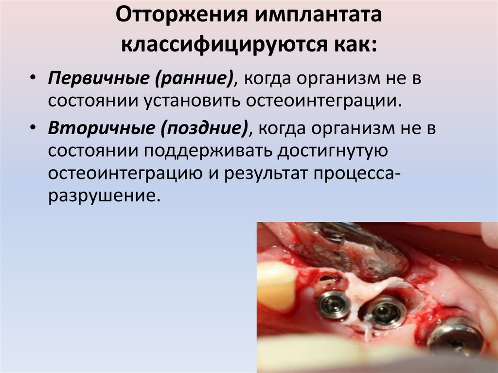 Отторжения имплантата классифицируются как: