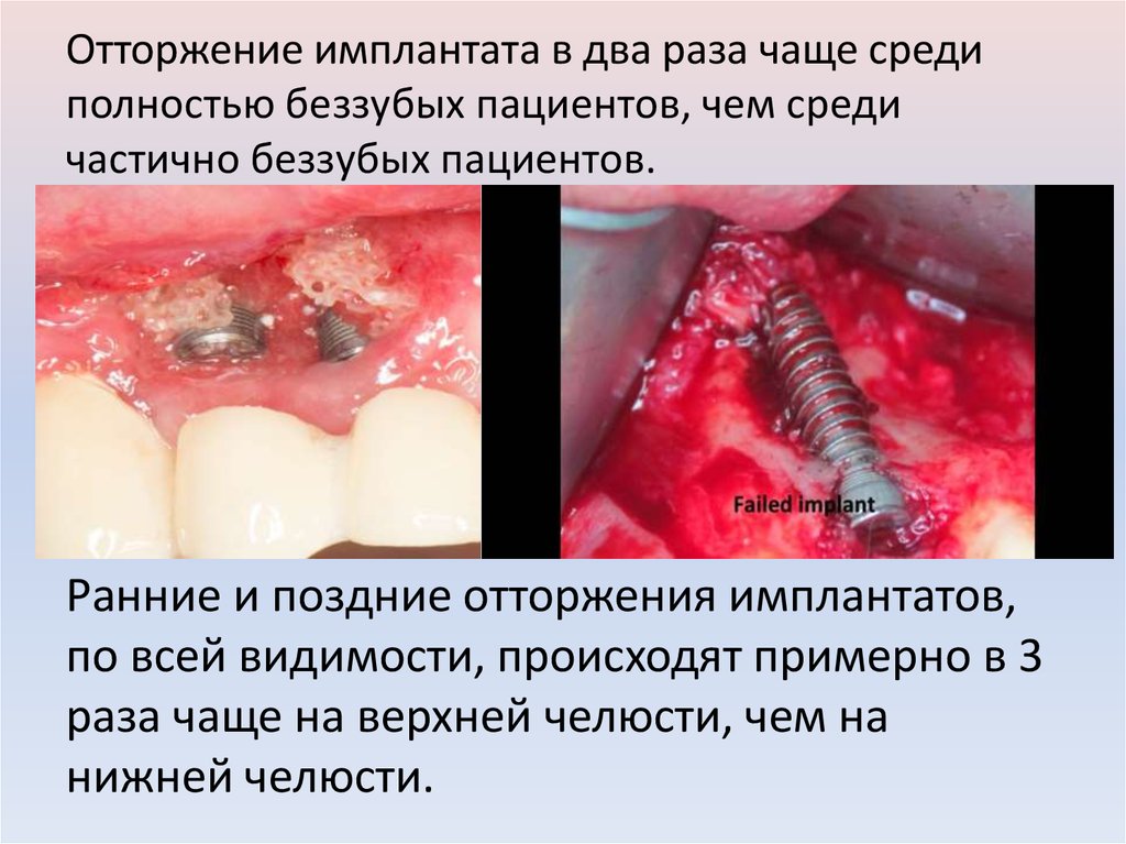 Отторжение имплантата в два раза чаще среди полностью беззубых пациентов, чем среди частично беззубых пациентов.