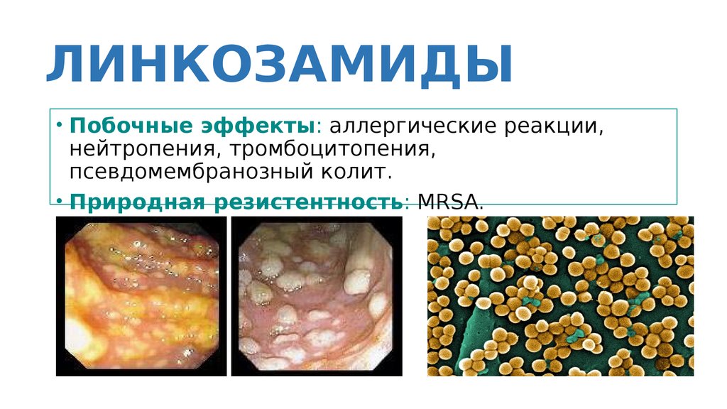 ЛИНКОЗАМИДЫ