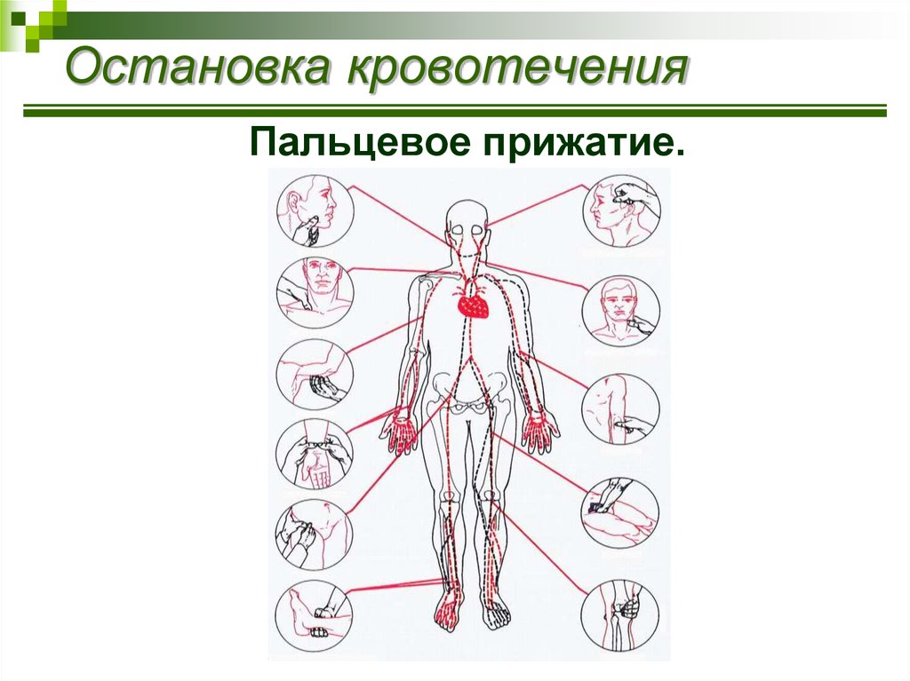 Способы остановки кровотечения пальцевое прижатие артерии