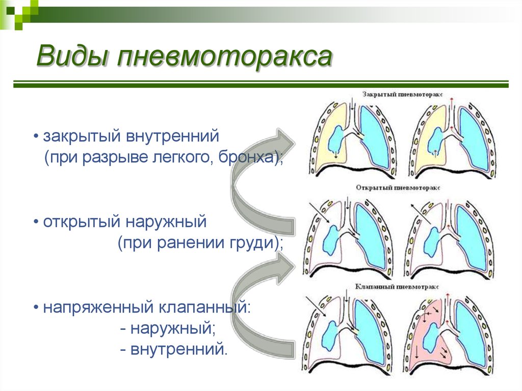 Клиническая картина открытого пневмоторакса