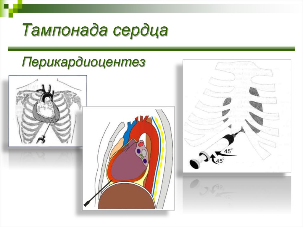 Тампонада. Тампонада сердца перикардиоцентез. Перикардиоцентез при тампонаде сердца. Скорость тампонады сердца.