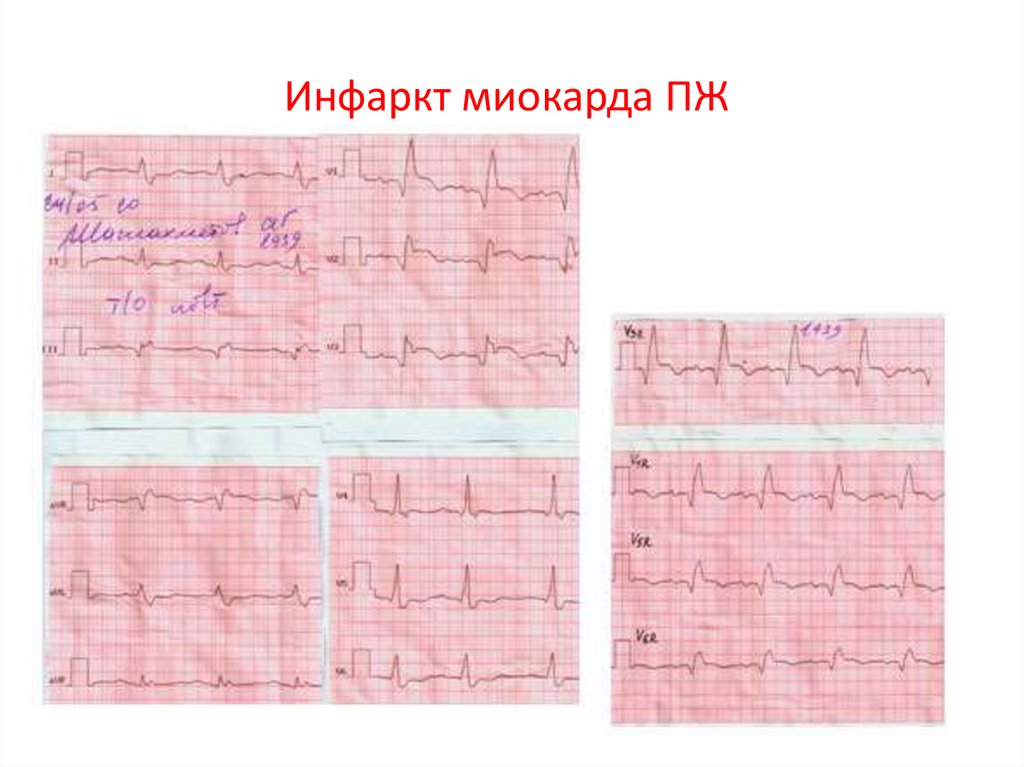 Фото кардиограммы при инфаркте. Заключение ЭКГ инфаркт миокарда. Острый инфаркт миокарда ЭКГ заключение. Инфаркт миокарда правого желудочка на ЭКГ. Острый инфаркт миокарда правого желудочка на ЭКГ.