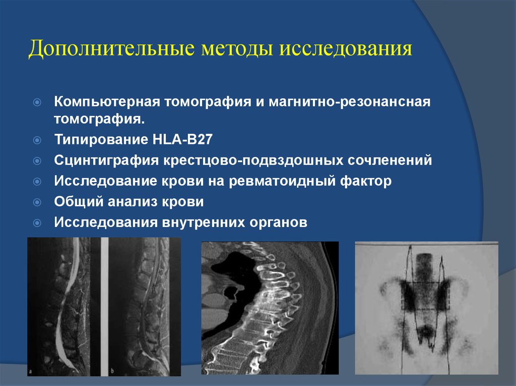 Какую картину дает мрт при болезни бехтерева