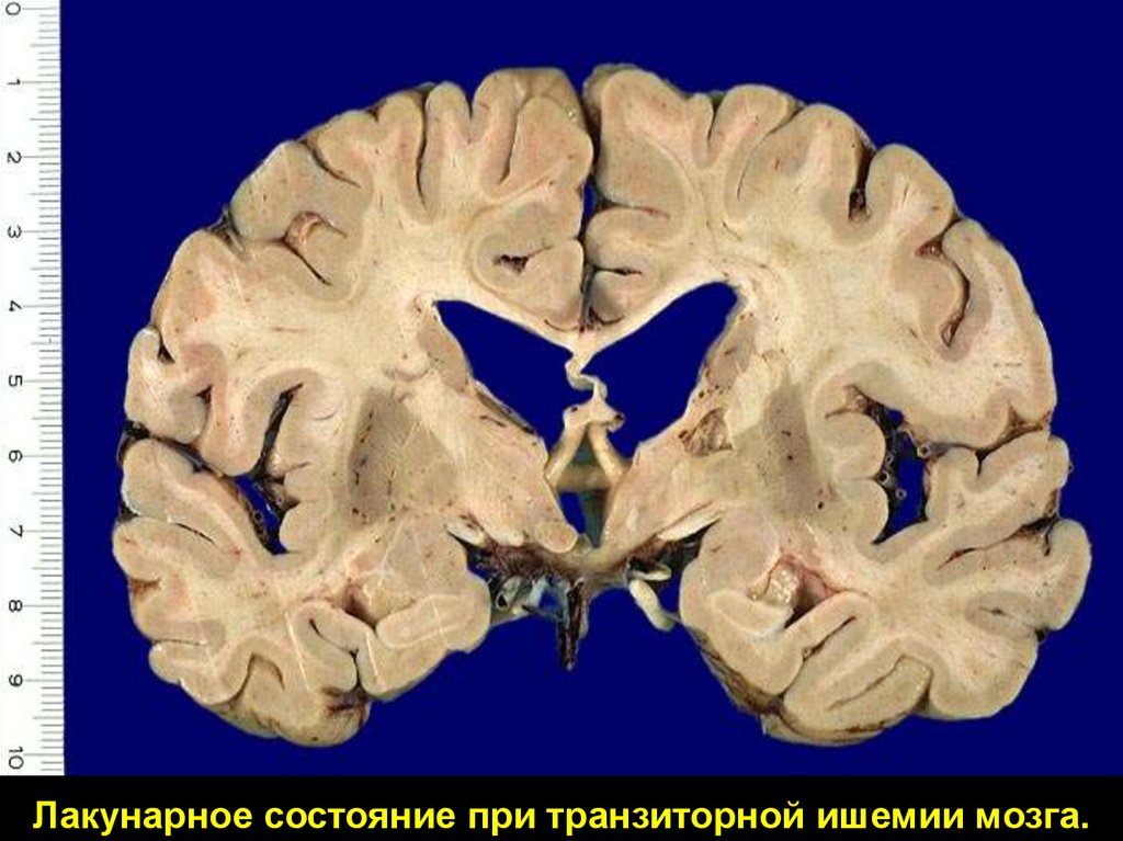 Лакунарная деменция. Лакунарное состояние мозга. Дегенерация головного мозга. Дегенерация белое вещество мозга. Лакунарные инфаркты головного мозга.